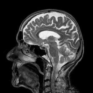 Brain Injury Imaging - Head Injury After a Car Accident